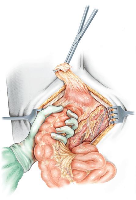 Mobilize the Sigmoid Mesentery Dissect proximally to the IMA Exposes the proximal node dissection