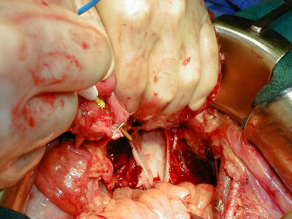 Resection Anterior Vagina