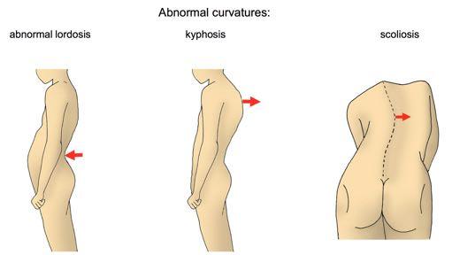 Abnormal curvature may occur which include o abnormal lordosis usually an exaggerated lumbar curve Obese man or pregnant women can develop this because the weight pulls the lumbar forward. o Kyphosis.