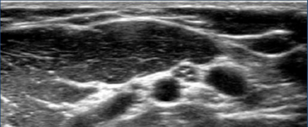 Get it right from insertion Use Ultrasound to define all anatomy Choose