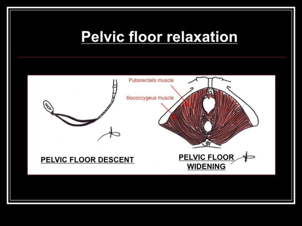 Fig.: pelvic floor