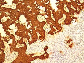 2. attēls. Citokeratīna CK AE 1/3 ekspresija bazālo šūnu karcinomas audos, 200, DacoCytomation.
