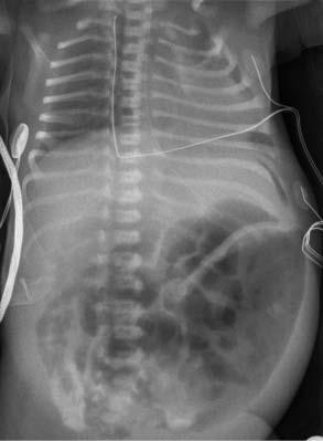 Ķirurģija 2. attēls. Brīvs gaiss vēdera dobumā NEK gadījumā priekšlaikus dzimuša bērna rentgenogrammā. X-ray image showing air in the abdominal cavity of a prematurely born infant suffering from NEC.