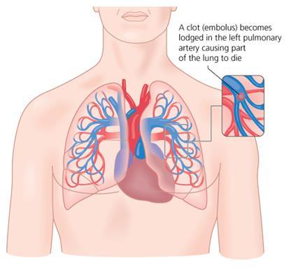 become dislodged from their sites of formation in venous valve pockets 1, and the weak force of venous luminal blood flow can be sufficient to