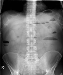 Rectal contrast = key for LBO diagnosis LBO: Metastasis Breast Carcinoma Fecal Impaction