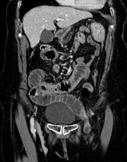 peritoneum or mesentery into a compartment within