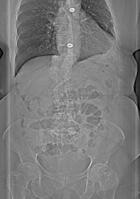 lumbar, obturator, incisional) in most cases visible or