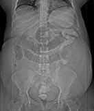 abdominal hysterectomy SBO: Ventral