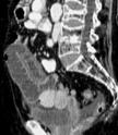 Strangulation obstruction (10% of SBO): - most are closed loop (= bowel loop occluded at two