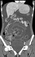 poststenotic bowel better determination of site and cause of obstruction MDCT: improved