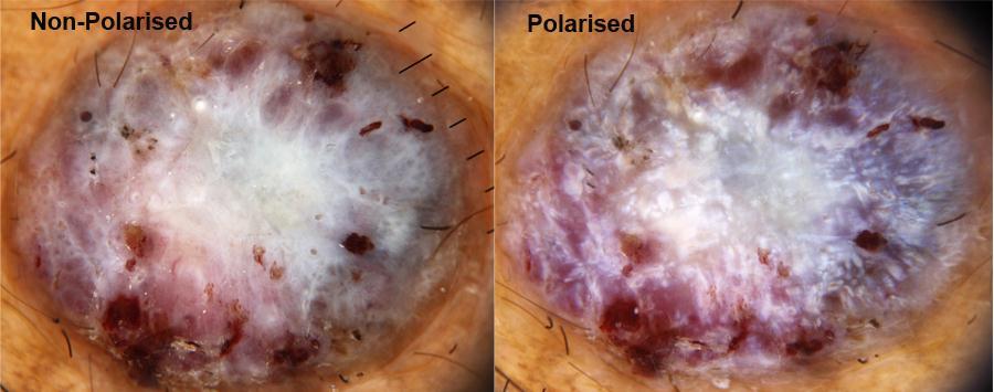 Nodular melanomas may be