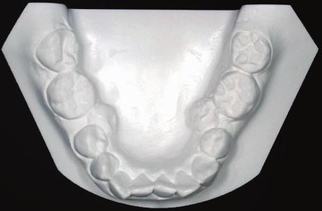 first molars were Class I, because of blocked-in