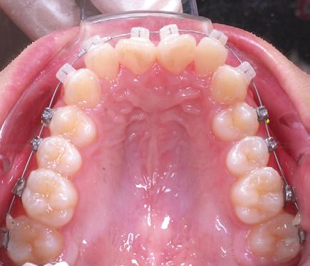 crimped stops mesial-distal to