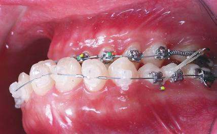 on first premolars.