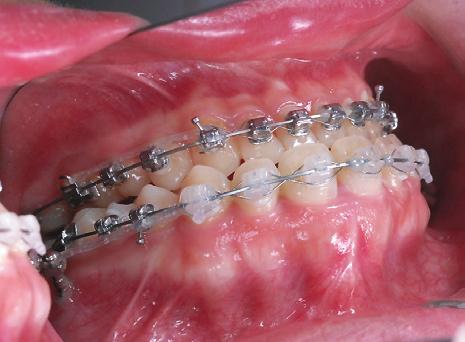 Elastomeric chains from the IZC bone screws to the