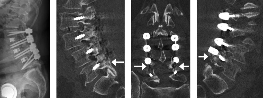 b) By contrast, CT showed bilateral fractures of the L5 pedicle, indicated by the white arrows. During revision, bone cement was injected through the cannulated pedicular screws.