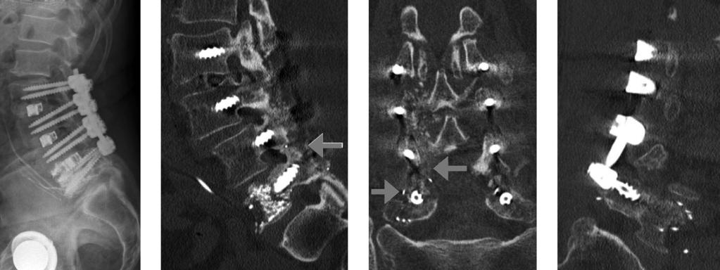 A decompression and fusion of L2-5 was performed with pedicular screws and transforaminal lumbar interbody fusion at each level.