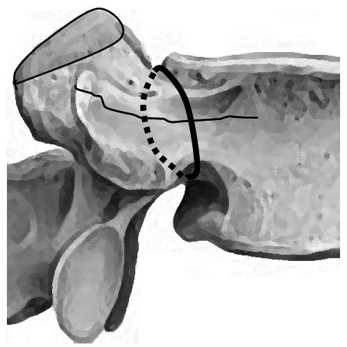 The screws in S1 were removed at five months after healing of the pedicular fracture had been confirmed by CT (Fig. 2). Operative technique.