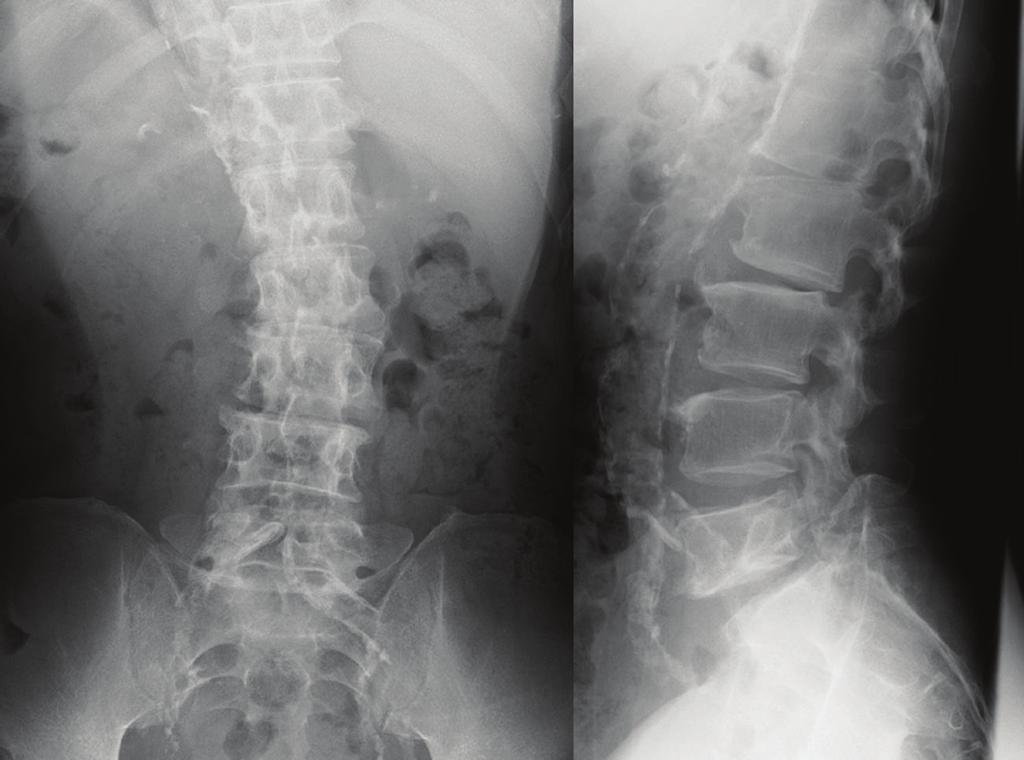 2 Case Reports in Orthopedics Figure 1: Plain radiographs showing a degenerative lumbar scoliosis and Meyerding grade I L5-S1 isthmic spondylolisthesis 2 years before surgery.