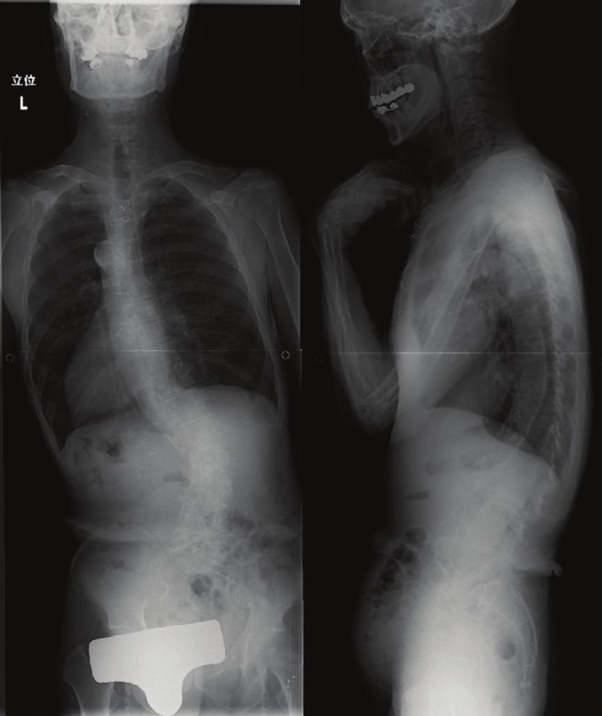 The patient underwent Gill laminectomy of L5 with pedicle screw fixation at L4-S1 and interbody fusion using the posterior lumbar interbody fusion (PLIF) technique at L5-S1.