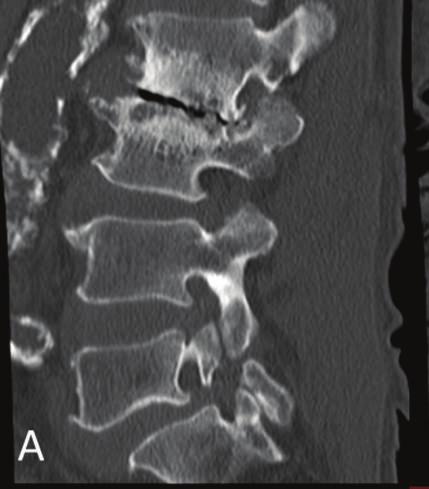 Case Reports in Orthopedics 3 Figure 4: Sagittal reconstruction CT confirming bilateral spondylolysis and destructive changes at L2-L3 and L5-S1 (A, B).