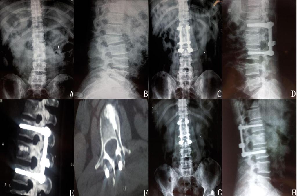 Figure 2. Preoperative and postoperative imaging of a 41-year-old male patient with L2 burst Fracture, type A3 with ASIA D neurological impairment. A, B.