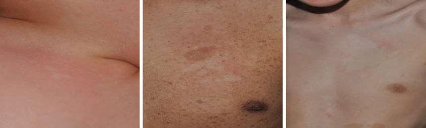 Nevus anemicus: clue to diagnosis of NF1 >50% of pediatric NF1 patients
