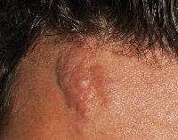 3) Angiofibromas ( 3) or fibrous cephalic plaque Ungual fibromas
