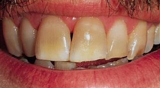 Fischer, Tanye, Thomson, Schreuder How does it work? Before Tooth whitening is more than dental cosmetics.