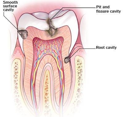 Dental Cavities and Tooth Decay Dental cavities are holes or structural damage in the teeth Plaque that gets accumulated on teeth, if not removed turns into tartar that causes tooth decay The acids