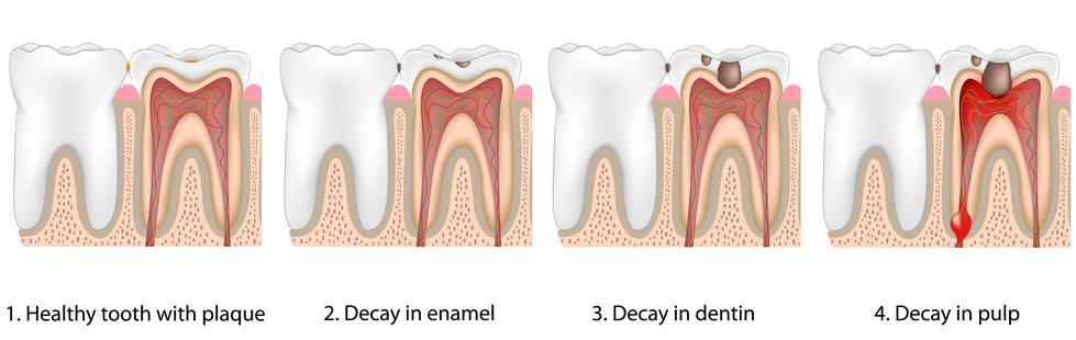 Symptoms There may be no symptoms for cavities or tooth decay, if they occur it includes: Tooth pain
