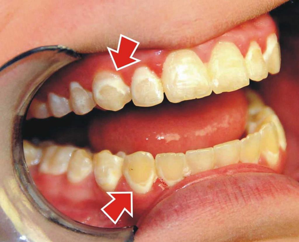 Teeth Discolouration Our teeth become yellow due to stains over time both deep and surface level Our teeth are not perfectly white by nature Tooth enamel the hard white surface of teeth, underneath