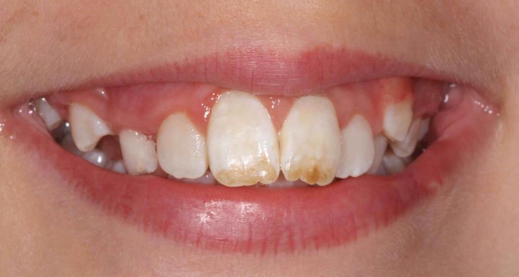Teeth Discolouration There are two types of stains that cause discolouration of teeth Intrinsic stains that develop inside the tooth enamel.