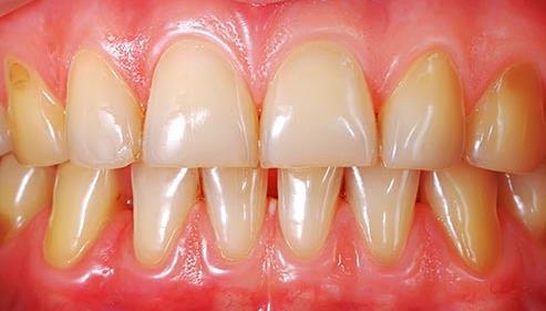 Dental Plaque Plaque is a sticky layer of material containing bacteria that accumulates on