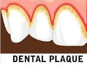 brushing and flossing After meals the bacteria in plaque use sugar and starch in food to