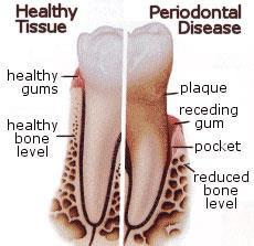 Gum Disease Gum disease, like inflammation (gingivitis), periodontitis, etc.