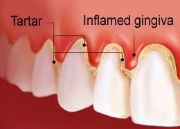 brushing If left untreated it can progress to more serious periodontitis The inner layer of gum and bone pull