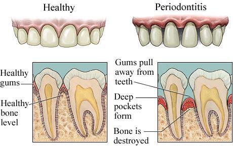 Gum Disease The three stages of gum disease from least to most