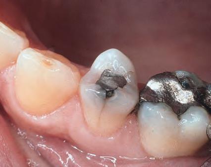 Microleakage: With age the amalgam has self-sealing property that decreases the microleakage due to the corrosion products that forms in the toothrestoration interface.