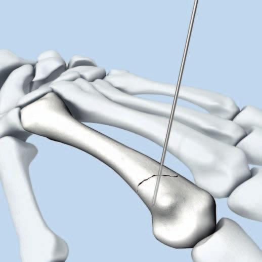 Implantation 1 Temporary fixation of fractures with Kirschner wires Reduction can be preliminary held with 1.0 mm K-wires not protruding the articular surface.