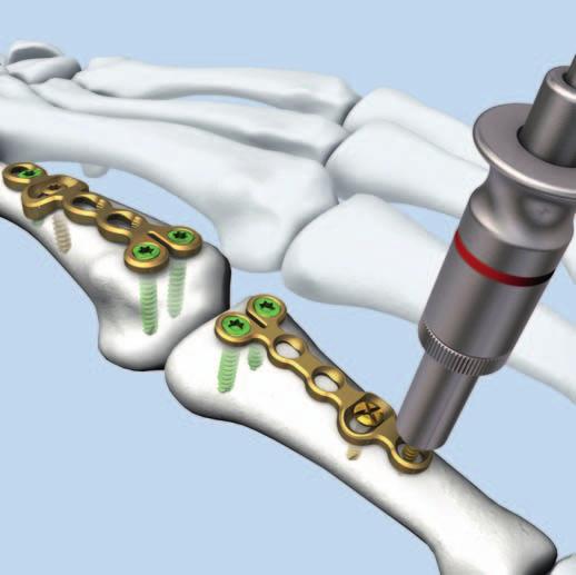 7 Final fixation Fix a screw in the optimum position distal or proximal to the transverse elongated hole. The other holes may remain free or can be fitted with additional cortex screws.