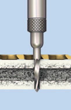 Note: For rotation correction plates 1.5/2.0 use the universal drill guide 1.5/1.1 for 1.5 mm cortex screws. Use the 1.1 mm drill bit for the threaded hole and a 1.