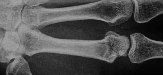 Case Studies Case 1 Subcapital comminuted fracture of the 2nd metacarpal bone