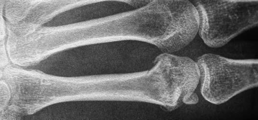 Compressed fracture of the metacarpal head with 4 mm shortening and 20 ulnar
