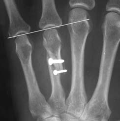Case studies Case 2 Pseudoarthrosis of the 4th metacarpal bone following failed screw osteosynthesis