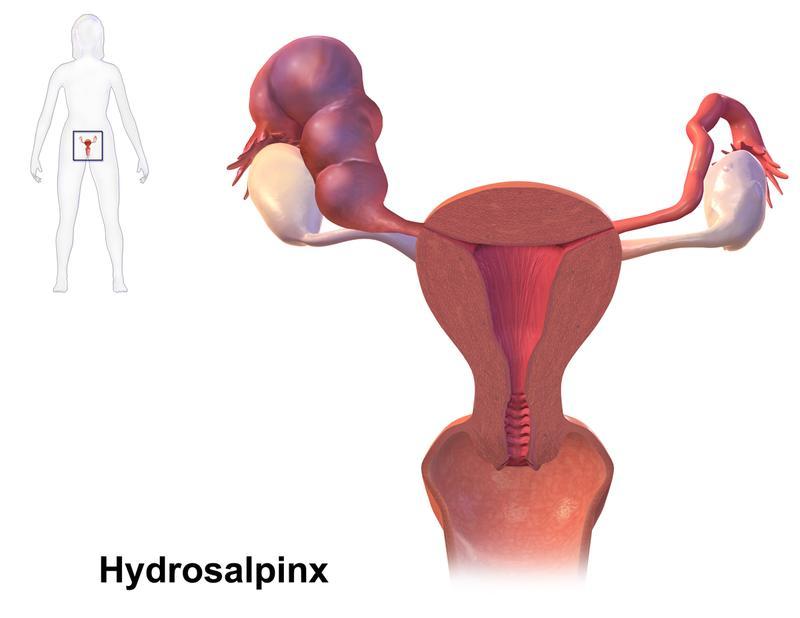 Females Causes: Fallopian Tube Dysfunction Affects ~25% of infertile couples, has a 30% success rate with best (usually surgical) treatment Infection Usually STI- viral or