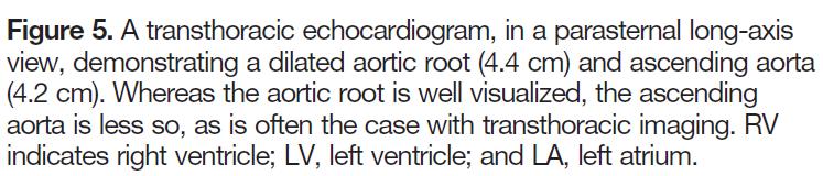 and Aortic Aneurysm -