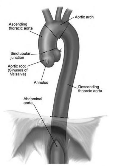 7/1 Aneurysma of the descending aorta 3 per 100.000 per year m/f = 4.