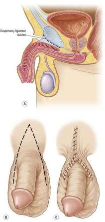 Penile lengthening procedures Division of suspensory ligament Approximately half of the penis is positioned inside the body. It is attached to the pubic bone by the suspensory ligament.