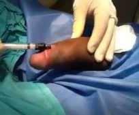 Penile girth enhancement Traditionally one of the most common procedures to enhance the thickness of the penis is the injection of fat (free fat transfer).